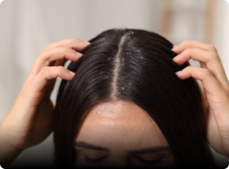 Dandruff